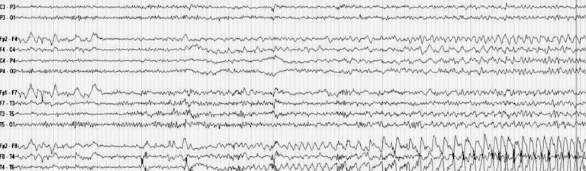 Electroencefalograma – EEG