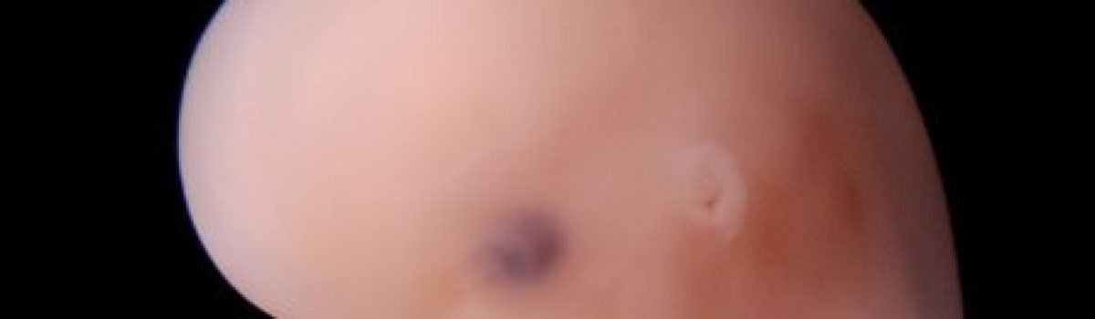 Malformaciones cerebrales y del sistema nervioso