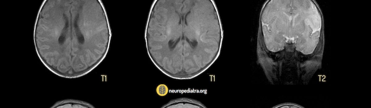 Hemiparesia en la parálisis cerebral infantil