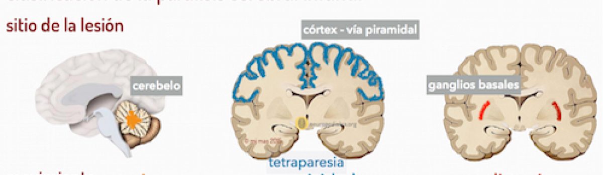 Tipos de parálisis cerebral infantil