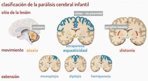clasificación parálisis cerebral