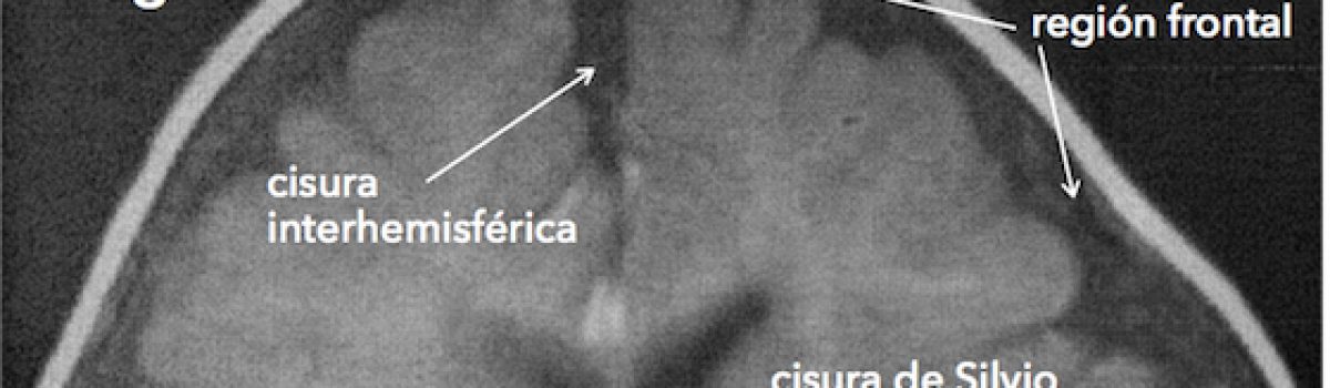 Macrocefalia benigna / hidrocefalia externa