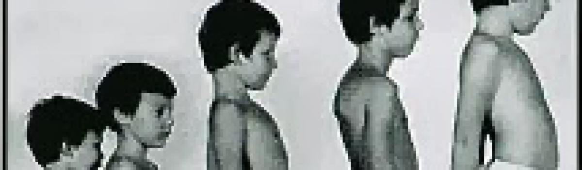 Distrofia muscular de Duchenne